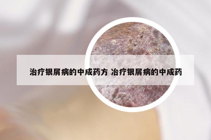 银屑病最新中成药